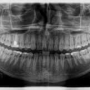 Tooth fistula: Read all the important information about the purulent inflammation in the oral cavity